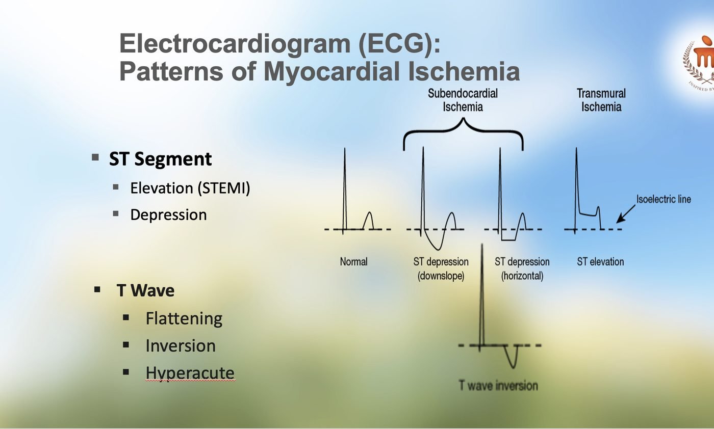 Lecture slide: ECG patterns of myocardial ischaemia. Normal complex, downsloping and horizontal ST depression under a bracket labelled subendocardial ischaemia, ST elevation labelled transmural ischaemia, and a T-wave inversion