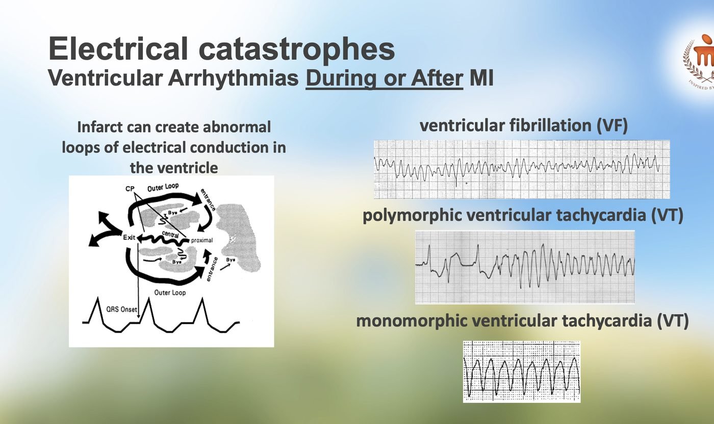 Lecture slide: electrical catastrophes, ventricular arrhythmias during or after MI. A diagram of a re-entrant loop through infarcted ventricle beside rhythm strips of ventricular fibrillation, polymorphic ventricular tachycardia and monomorphic ventricular tachycardia