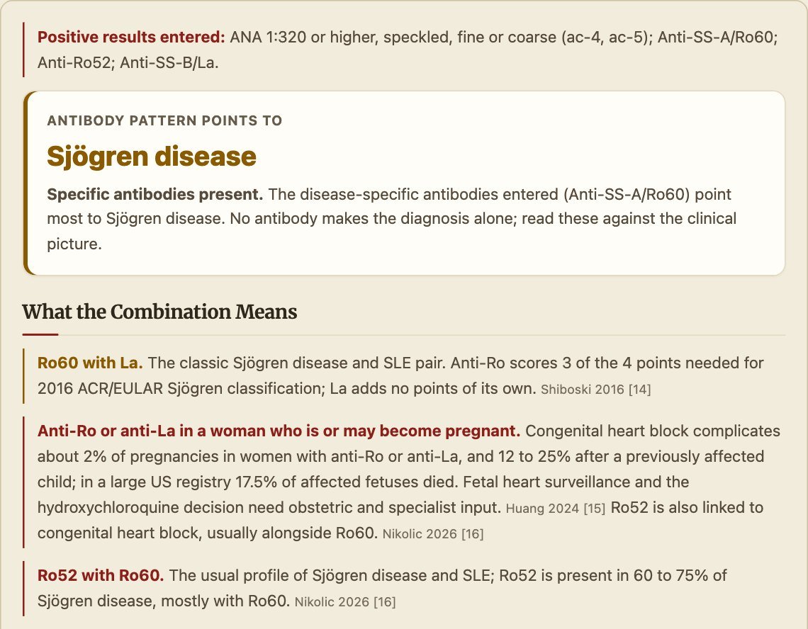 Autoantibody Interpretation Guide result for ANA 1:320 speckled with anti-Ro60, anti-Ro52 and anti-La: the pattern points to Sjogren disease, with notes on what each combination means including the pregnancy risk of congenital heart block